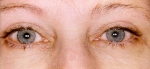 Blepharoplasty is a cosmetic eye surgery for saggy eyelids