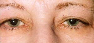 Blepharoplasty is a cosmetic eyelid surgery for droopy eyelids