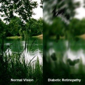 Diabetic retinopathy_web