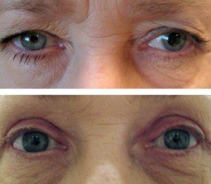 Before and after blepharoplasty