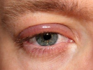 Blepharitis