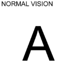 Normal Vision