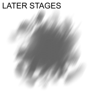later stages of keratoconus
