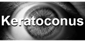 Banner for Keratoconus Blog