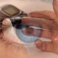 diabetes-and-the-eye-carlinvision-blog-image